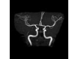3D HD MIP timmed image of the anterior arterial circulation.