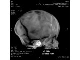 3D CT MIP: Lateral image to demonstrate the sutures in a baby's head to check for a congenital defect that causes one or more sutures on a baby's head to close earlier.