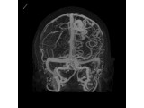 3D Cranial CT Venogram demonstrating an arteriovenous malformation.