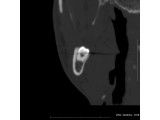 Volume rendered image of the Right Mandible: Image created to demonstrate the relationship of the nerve root to the wisdom tooth.