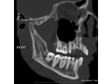 Volume rendered image of the Right Mandible: Image created to demonstrate the relationship of the nerve root to the wisdom tooth.