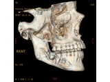 3D MIP image of the Inferior Aveolar Nerve: Image created to demonstrate the relationship of the nerve root to the wisdom tooth.