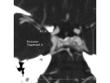 Per Trigem MIP 2 