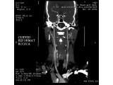 Head and Neck CTA: Curved reformation of the Right Common and Internal Carotid artery.