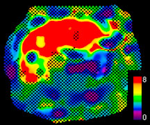 Color Elastogram Calculated from the wave map. Provides a visual color-coded graphic of tissue stiffness.