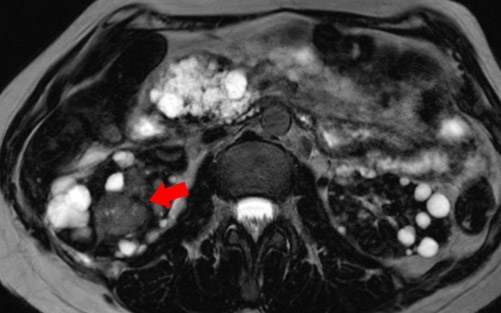 Renal Masses stand out in the background of multiple bilateral renal and pacreatic cysts (arrows).