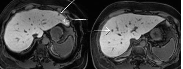 tumor dikke darm