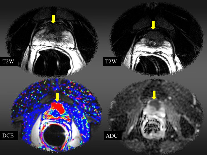 68 year old male patient with rising PSA and multiple negative trans-rectal ultrasound guided biopsies. MRI demonstrates ill-defined crescentic area of T2 hypointensity anteriorly in the transitional zone, with corresponding abnormal perfusion and restricted diffusion representing tumor. This was confirmed on repeat biopsy targeting this area