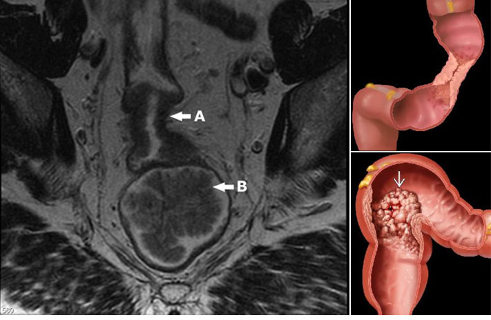 (A) "Apple-core" tumor of the rectosigmoid, with circumferential irregular thickening consistent with colonic adenocarcinoma. (B) Polypoid mass in the rectum, with a shaggy nodular contour, sometimes likened to the appearance of a cauliflower.