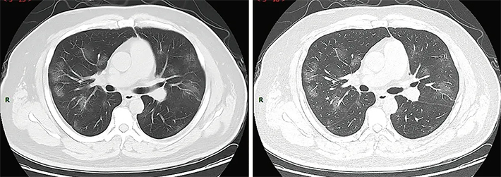 Figure 1. A 14-year-old male cross-country runner was experiencing knee pain. A knee MRI using T2 sequences revealed a stress fracture in the proximal tibia. Images courtesy of Randheer Shailam, MD, Pediatric Imaging, Department of Radiology, Massachusetts General Hospital.